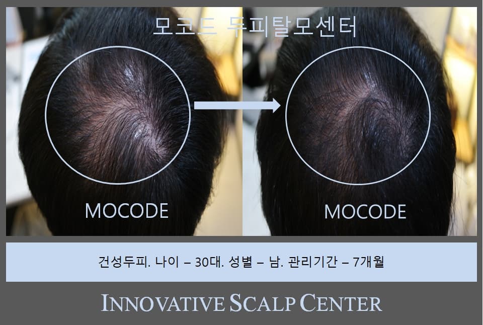 건성두피 탈모 관리 전후 비교 - 30대 남성