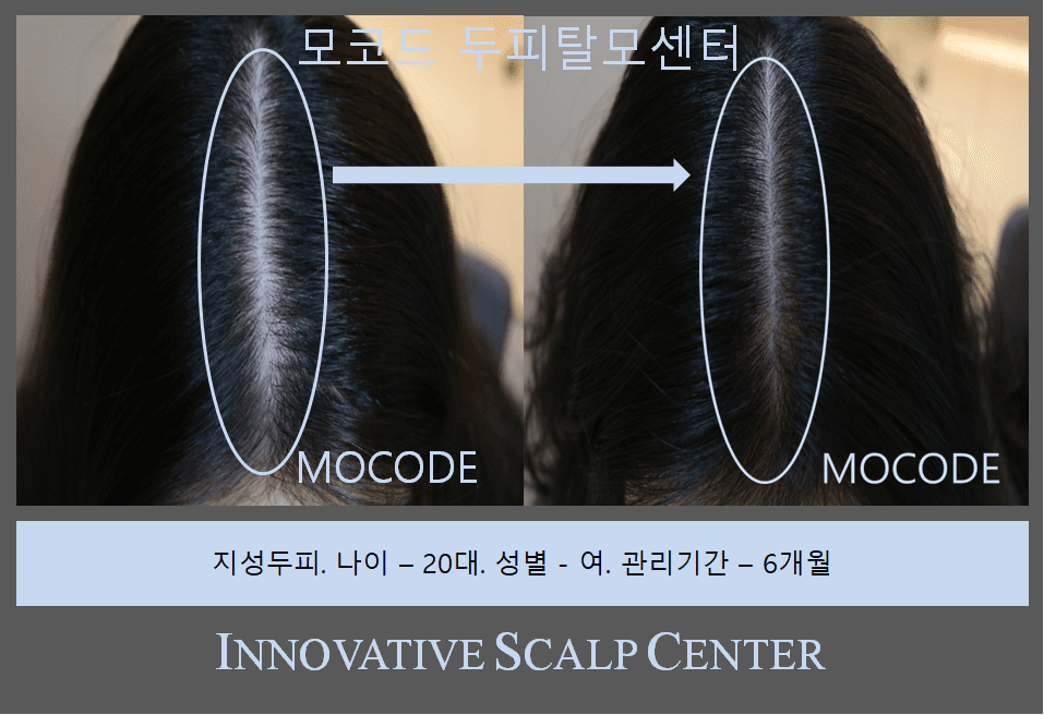지성두피 탈모 관리 전후 비교 - 20대 여성