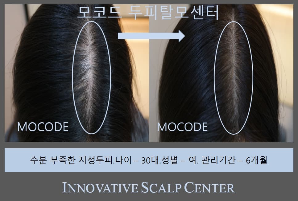 원형탈모 관리 전후 비교 - 30대 여성