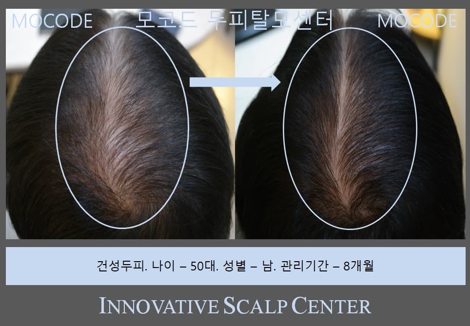 원형탈모 관리 전후 비교 - 50대 남성