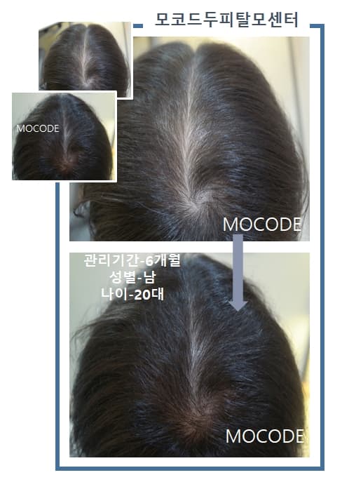 모발 재성장 관리 전후 비교 - 20대 남성