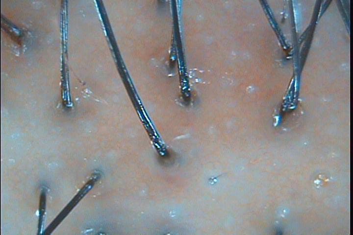 지루성 두피 관리 전후 비교