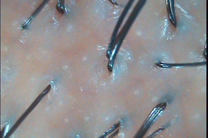 민감성 두피 관리 전후 비교