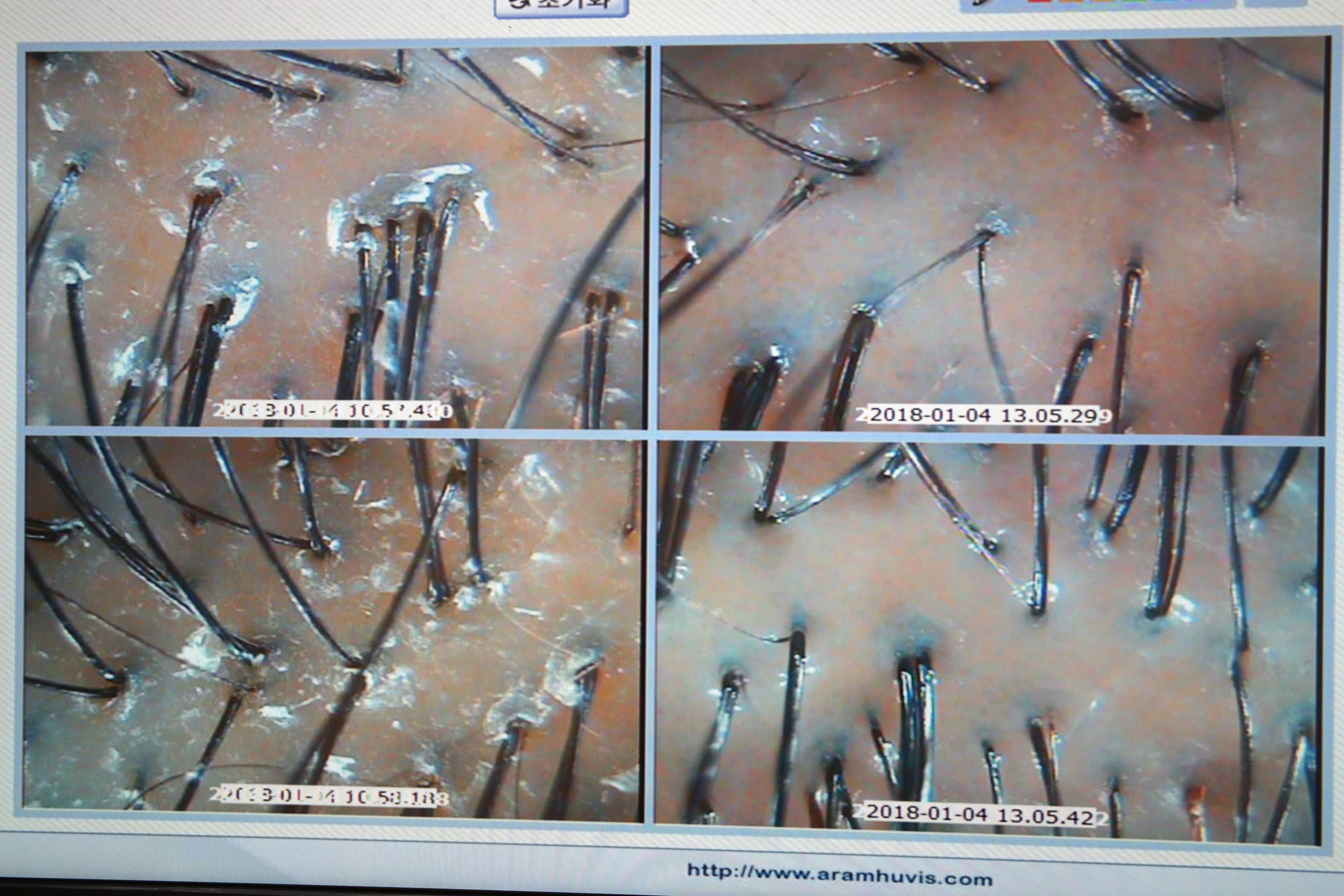 두피 현미경 관리 전후 비교 분석