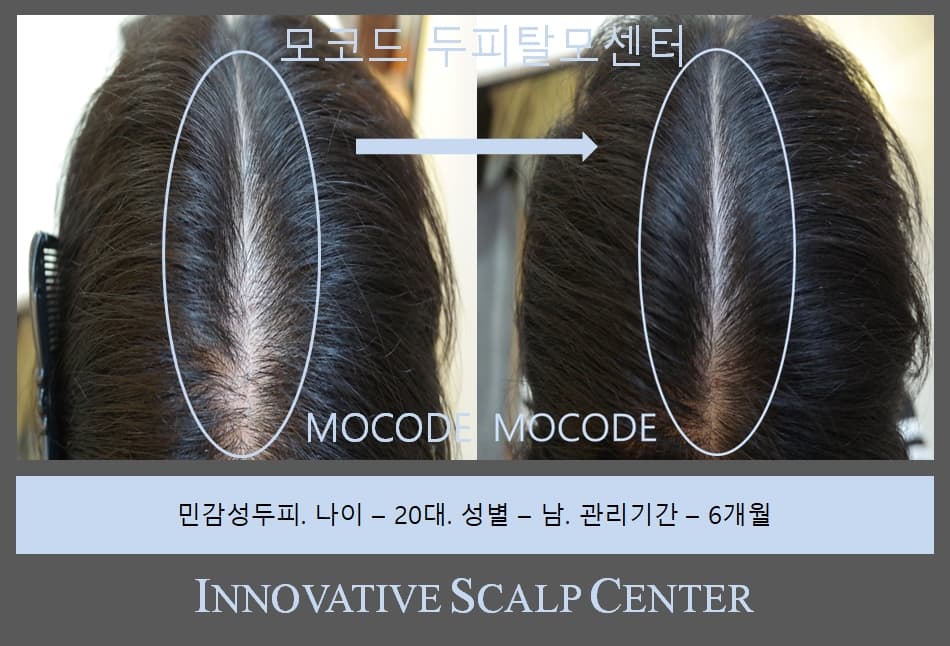 모발 관리 사례 1 - 관리 전후 비교