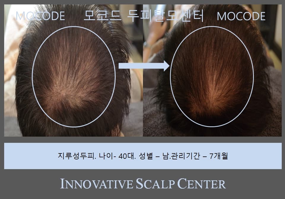 두피 클로즈업 1 - 관리 전후 비교