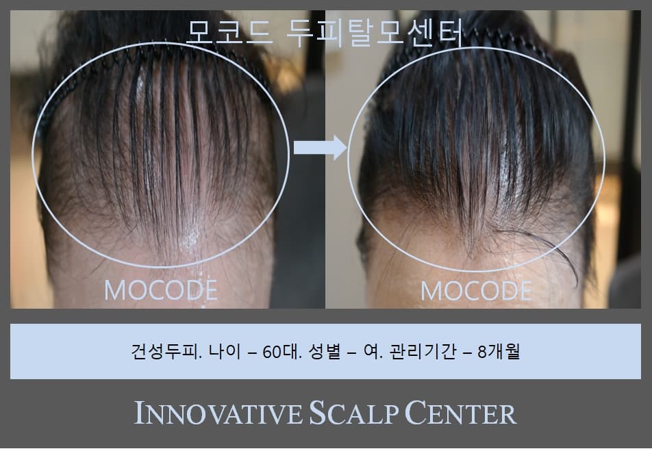 두피 현미경 비교 분석