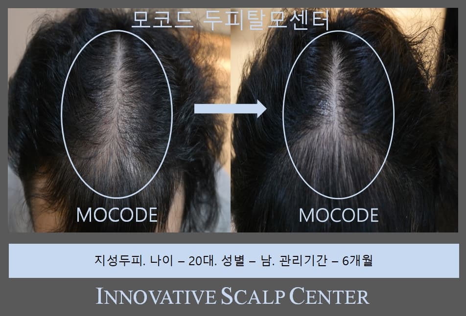 두피 현미경 분석 1